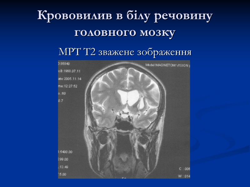 Крововилив в білу речовину головного мозку МРТ Т2 зважене зображення